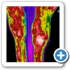 Significant inflammation in the
left hock, confirmed as a large
bone spur and joint
degeneration.